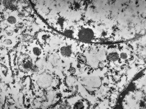 F,72y. | melanoblastoma oculi